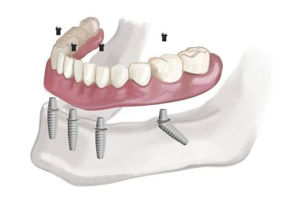 What Are All on 4 Dental Implants