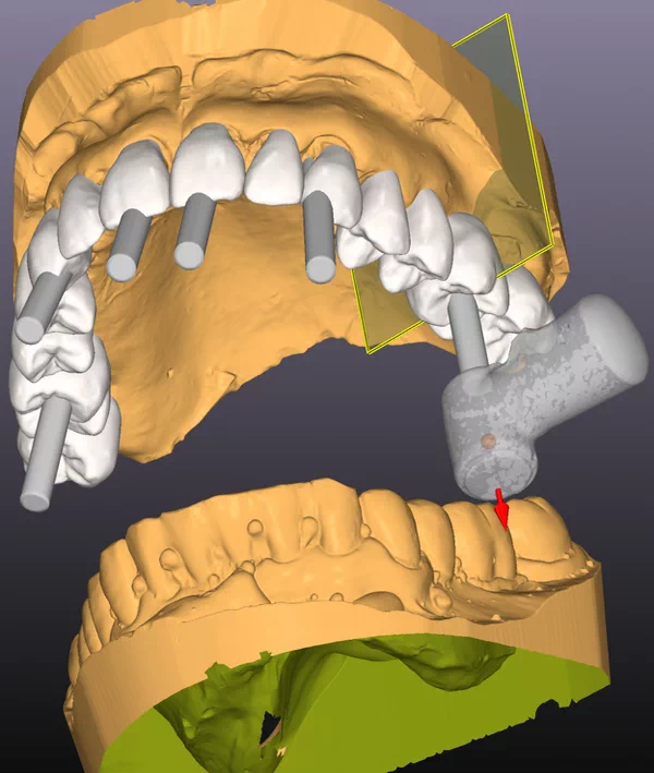 3D imaging and digital planning