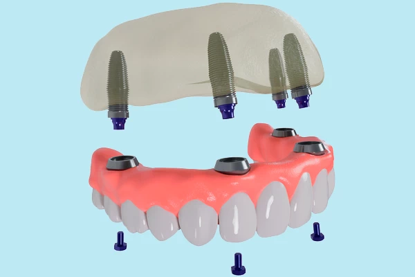 What Are All-on-4 Implants